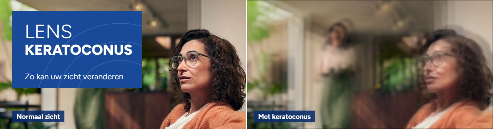 Keratoconus