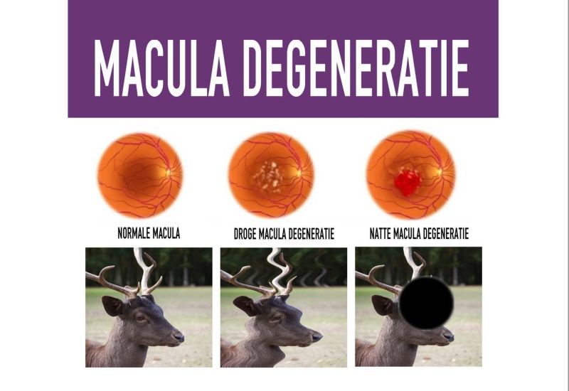 Macula degeneratie